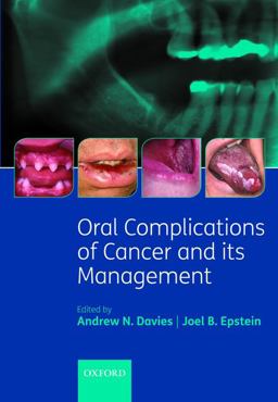 Oral Complications of Cancer and Its Management