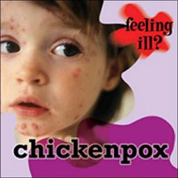 Chickenpox