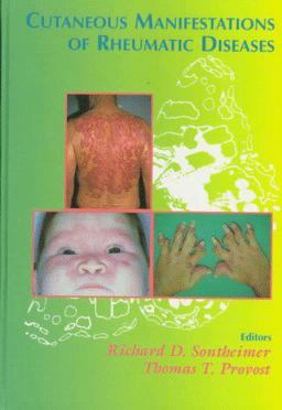 Cutaneous Manifestations of Rheumatic Diseases 1st 1996 9780683078527 Front Cover