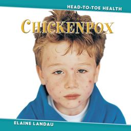 Chickenpox