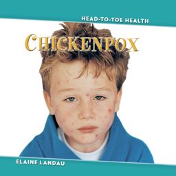 Chickenpox