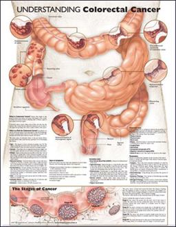 Understanding Colorectal Cancer Anatomical Chart  9780781773331 Front Cover