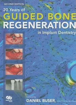 20 Years of Guided Bone Regeneration in Implant Dentistry 2nd 9780867154016 Front Cover