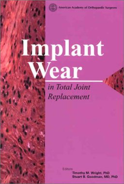 Implant Wear in Total Joint Replacement