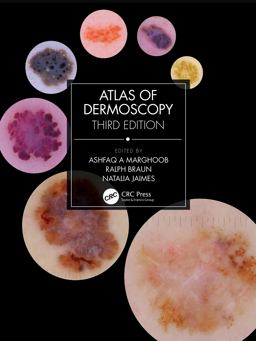Atlas of Dermoscopy 3rd 9781138595989 Front Cover