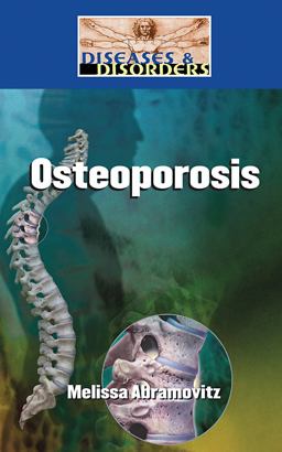 Osteoporosis Osteoporosis