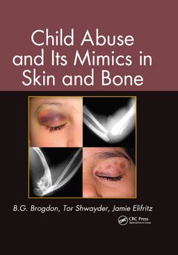 Child Abuse and Its Mimics in Skin and Bone  9781439855355 Front Cover