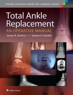 Total Ankle Replacement: An Operative Manual, North American Edition  9781451185225 Front Cover
