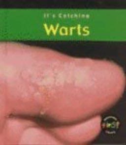 Warts