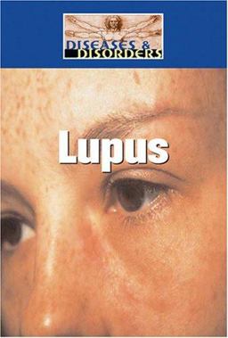 Lupus Lupus