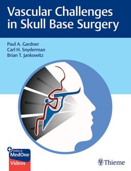 Vascular Challenges in Skull Base Surgery  9781684200689 Front Cover