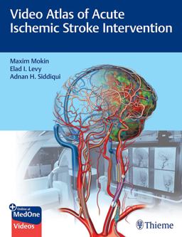 Video Atlas of Acute Ischemic Stroke Intervention:  9781684202492 Front Cover