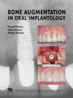 Bone Augmentation in Oral Implantology  9781850971597 Front Cover