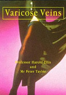 Varicose Veins