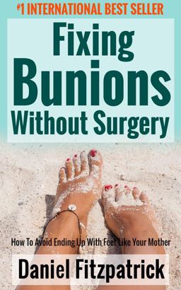 Fixing Bunions with Out Surgery