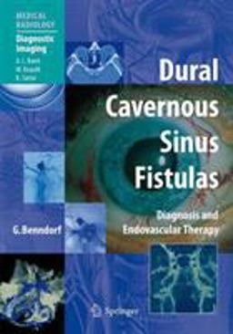 Dural Cavernous Sinus Fistulas Diagnosis and Endovascular Therapy  9783540008187 Front Cover