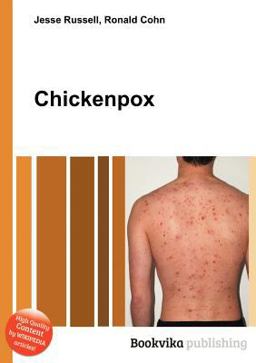 Chickenpox