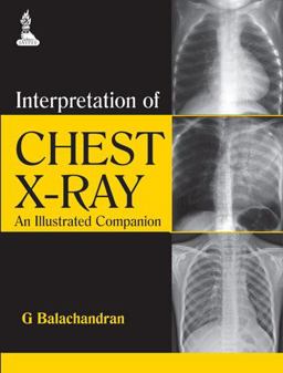 Interpretation of Chest X-Ray An Illustrated Companion  9789351521723 Front Cover